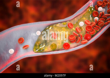 Atheromatous Plakette im Blutgefäß, Computer Bild. Ein Atherom Cholesterin verursacht eine Verengung einer Arterie (Arteriosklerose). Stockfoto