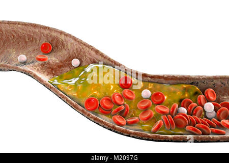 Atheromatous Plakette im Blutgefäß, Computer Bild. Ein Atherom Cholesterin verursacht eine Verengung einer Arterie (Arteriosklerose). Stockfoto