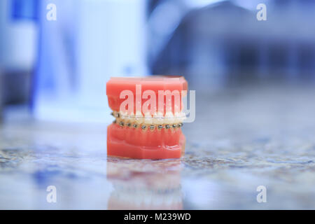 Zahn Modell mit Metall verdrahtet Zahnspangen. Zähne kieferorthopädische zahnmedizinische Modell mit Zahnspangen Implantate oder menschlichen Kiefers. Bild des Gebisses. Stockfoto
