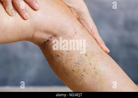 Womans Bein nach Krampfadern Chirurgie, mit sichtbaren chirurgisches Nahtmaterial (Stiche) und Wunden am Bein. Eine kurative Behandlung, ästhetische Verfahren, thro Stockfoto