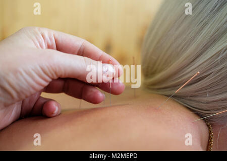 Junge Frau, Akupunktur in der Therapie. Weibliche Patienten, Akupunktur, Nahaufnahme. Soft Focus Stockfoto