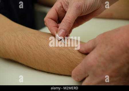 Epikutantests auf der Haut von arm. allergologie. Arzt offenbart das Allergen Stockfoto