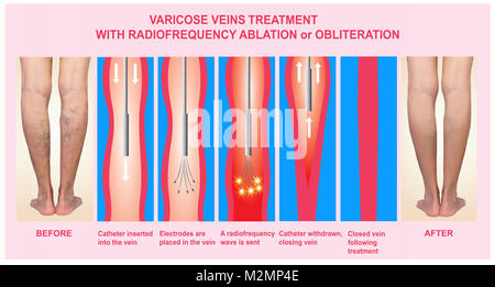 Krampfadern und Behandlung mit radiofrequenzablation Stockfoto