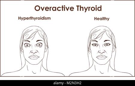 Eine erwachsene Frau, die die Symptome einer Hyperthyreose. Stock Vektor