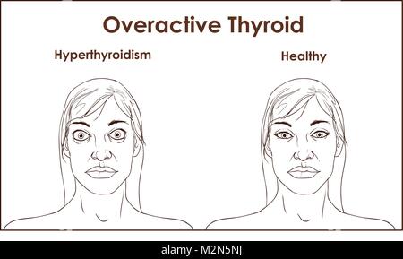 Eine erwachsene Frau, die die Symptome einer Hyperthyreose. Stock Vektor