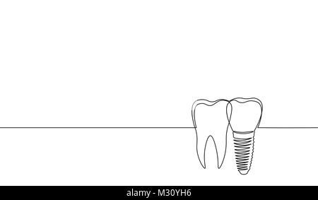 Eine durchgehende Linie kunst anatomischen menschlichen Zahn Implantat Silhouette. Gesunde Medizin recovery Molare root cavity Konzept Design Welt Mundgesundheit Tag einer Skizze Maßbild Vector Illustration Stock Vektor