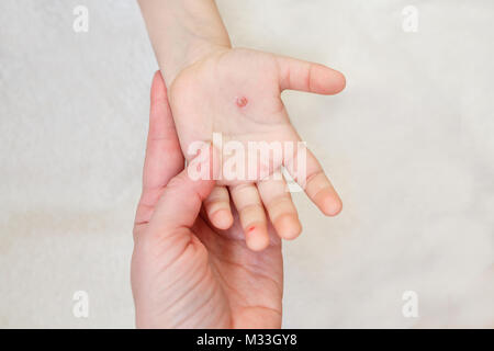 Die Hand eines Kindes mit Windpocken in der Hand der Mutter. Blasen an der Hand von windpocken Stockfoto