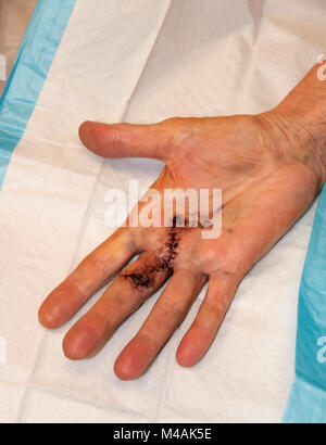 Woman's Hand mit Stichen noch an Ort und Stelle einen Monat nach Dupuytren Kontraktur der Chirurgie ihren dritten Finger und Handfläche zu korrigieren. Stockfoto