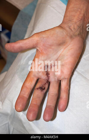 Woman's Hand mit Stichen nur entfernt einen Monat nach der Operation Dupuytren Kontraktur, Finger und Handfläche zu korrigieren. Stockfoto