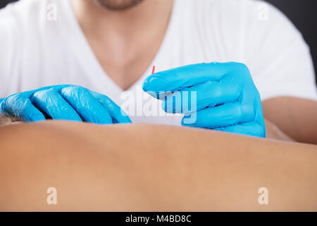 Nahaufnahme einer Physiotherapeutin, Akupunktur auf der Rückseite Stockfoto