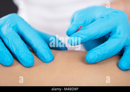 Nahaufnahme einer Physiotherapeutin, Akupunktur auf der Rückseite Stockfoto