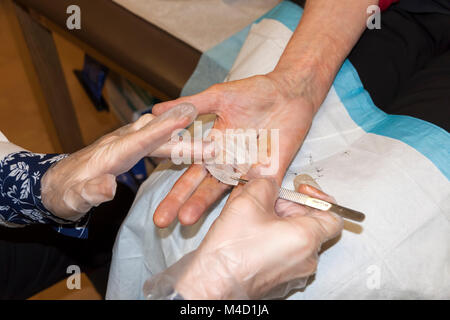 Schützende Gaze wird an Hand einer Frau angewendet, nachdem Stiche werden entfernt (einen Monat nach der Dupuytren Kontraktur der Chirurgie). Stockfoto