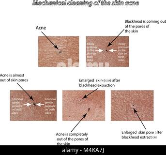 Mechanische Reinigung der Haut bei Akne. Stock Vektor