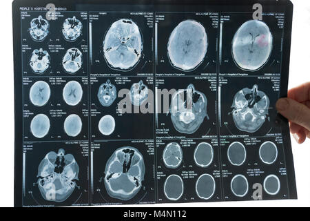 X-ray Bild des Gehirns in der Hand des Arztes auf weißem Hintergrund Stockfoto