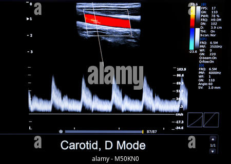 Bunte Bild von homan Herz-ultraschall-Monitor Stockfoto