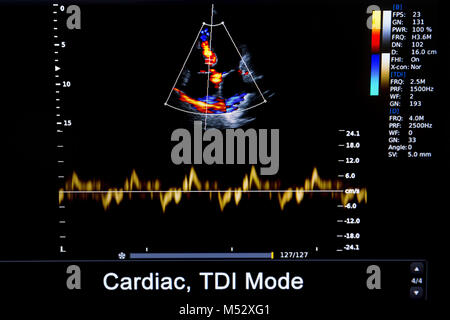 Bunte Bild von homan Herz-ultraschall-Monitor Stockfoto