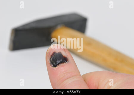 Blauer Fingernagel und Hammer Stockfoto