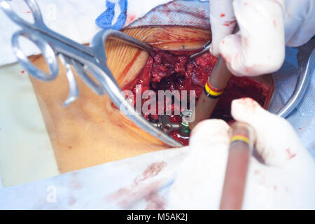 Chirurgischer Eingriff im Krankenhaus Stockfoto