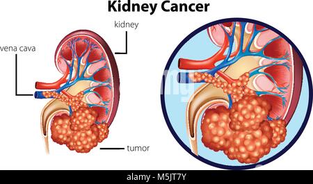 Diagramm mit Nierenkrebs Abbildung Stock Vektor