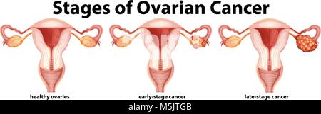 Diagramm mit Phasen der Eierstockkrebs Abbildung Stock Vektor