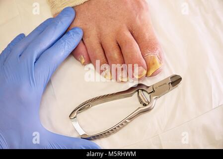 Pilz auf den Zehen Nägel. Twisted Zehen am Fuß mit Schwielen. Hallux rigidus neigt zu beeinflussen Männer Fuß. Stockfoto