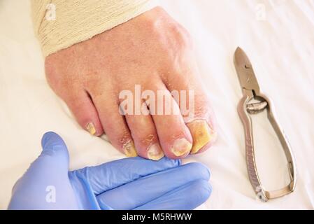 Pilz auf den Zehen Nägel. Twisted Zehen am Fuß mit Schwielen. Hallux rigidus neigt zu beeinflussen Männer Fuß. Stockfoto