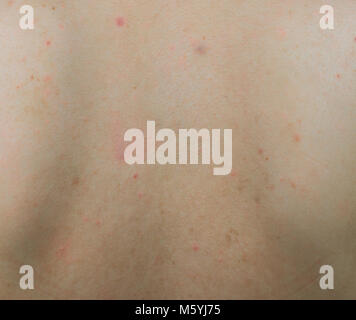 Nahaufnahme der Akne auf der Rückseite mit roter Fleck und dunklen braunen Fleck auf Frau zurück Haut. Stockfoto