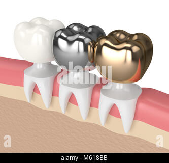 3D-Render der Zähne mit Gold, Amalgam und Komposit zahnmedizinische Krone im Zahnfleisch Stockfoto