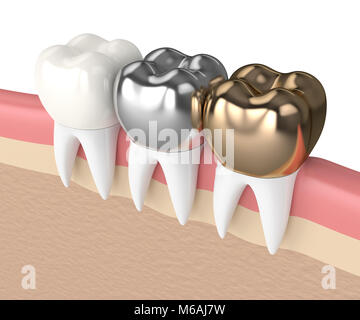 3D-Render der Zähne mit Gold, Amalgam und Komposit zahnmedizinische Krone im Zahnfleisch Stockfoto