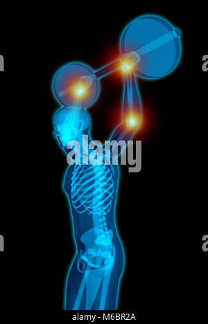 Sehr ausführliche und medizinisch genaue 3D-Illustration einer transluzenten Mann Gewichte zu heben, während mit Schmerz in seiner Gelenke Stockfoto