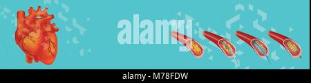 Menschliche Herz Banner. Angioplastie ist ein Endovaskuläres Verfahren zu erweitern Arterien oder Venen verengt oder verstopft, in der Regel zur Behandlung von arteriellen atheroscle Stock Vektor