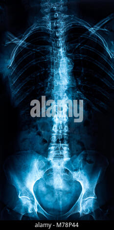 Frau trunk x-ray, Wirbelsäule lumbosacral Prüfung Stockfoto