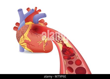 Blutkörperchen können nicht in das menschliche Herz fließen, weil verstopfte Arterien von Fettsäuren. Stock Vektor