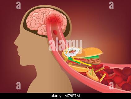 Blut kann nicht in menschliche Gehirn fließen, weil fast food gemacht verstopften Arterien. Stock Vektor