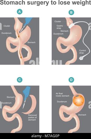 Arten der bariatrischen Chirurgie. Teil des menschlichen Körpers. Infografik Vektor. Stock Vektor