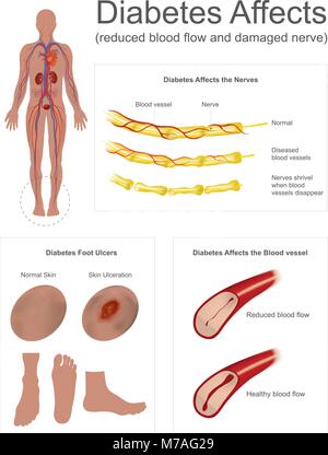 Die Nerven im Bein verkümmern, wenn Blutgefäße verschwinden. Ulcera sind eine häufige Komplikation schlecht kontrollierter Diabetes. Info Grafik Vektor. Stock Vektor