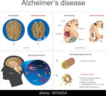 Gehirnzellen sterben, Neuron erkrankten, bestimmte Bereiche des Gehirns Gedächtnisverlust oder Änderungen im Speicher für Menschen im Alter von 65 Jahren und bis in Gefahr Jüngere könnte Schwund Stock Vektor