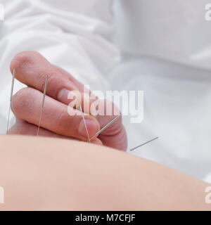 Akupunktur Nadeln auf eine Person anwenden Stockfoto