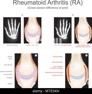 Die rheumatoide Arthritis ist eine chronische entzündliche Erkrankung, die mehr als nur ihre Gelenke auswirken können. Info Grafik Vektor. Stock Vektor