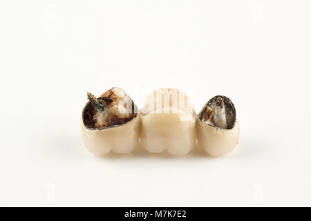 Beschädigte cermet Prothese mit gebrochenen Teile der Zähne Stockfoto