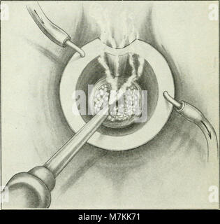 Ein Handbuch der gynaecology und Operationen im kleinen Becken, für Studenten und Praktiker (1916) (14767690385) Stockfoto