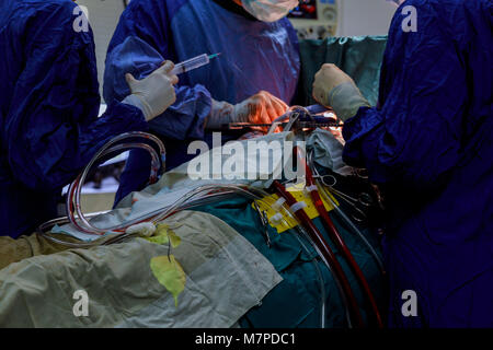 Offenes Herz Herz Bypass Chirurgie in Betrieb zimmer Ärzte Team Wear blue coat Herzchirurgie am Op durchführen Stockfoto