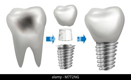Zahnimplantat Vektor. Zahn mit Karies. Gesundheit Zahnimplantate. Zahnklinik Zahnmedizin Flyer. Realistische isoliert Abbildung Stock Vektor
