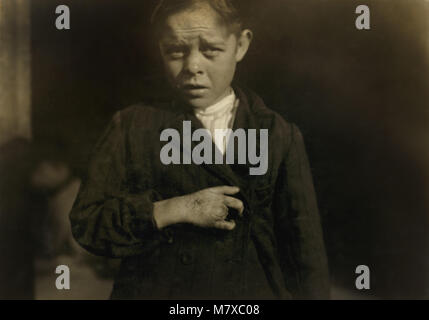 Giles Edmund Newsom, Junge Cotton Mill Worker, 12 Jahre alt, fielen auf die Spinnmaschine und seine Hand fuhr in ungeschützten Gearing, verloren, zwei Finger, Brustbild, Sanders Spinnerei, Bessemer City, North Carolina, USA, Lewis Hine für nationale Kinderarbeit Ausschuss, Oktober 1912 Stockfoto