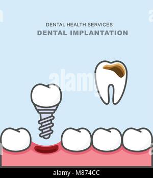 Zahnimplantat anstelle von kariösen Zahn - Zähne Prothetik Stock Vektor