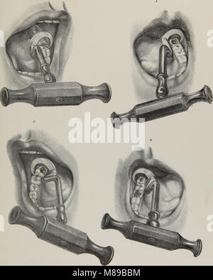 Extraktionen-1; die Anatomie, Physiologie und Pathologie des menschlichen Zähnen (1844). Stockfoto