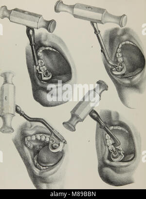 Extraktionen-2; die Anatomie, Physiologie und Pathologie des menschlichen Zähnen (1844). Stockfoto