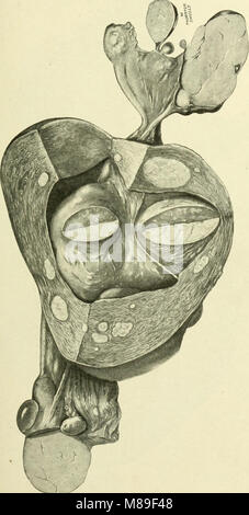 Myome und alliierten Tumoren (Myome und adenomyoma) - ihre Pathologie, klinische Merkmale und chirurgische Behandlung (1918) (14594067197) Stockfoto