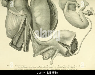 Myome und alliierten Tumoren (Myome und adenomyoma) - ihre Pathologie, klinische Merkmale und chirurgische Behandlung (1918) (14594113947) Stockfoto