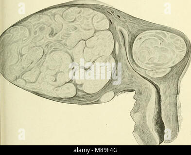 Myome und alliierten Tumoren (Myome und adenomyoma) - ihre Pathologie, klinische Merkmale und chirurgische Behandlung (1918) (14778264464) Stockfoto